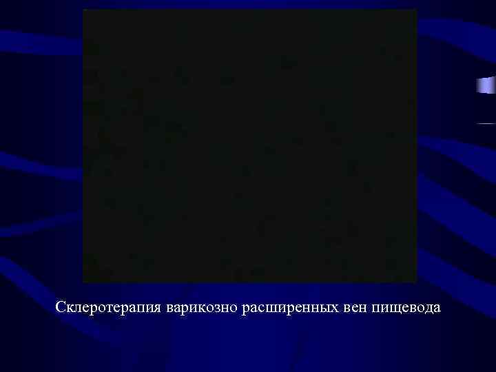 Склеротерапия варикозно расширенных вен пищевода 