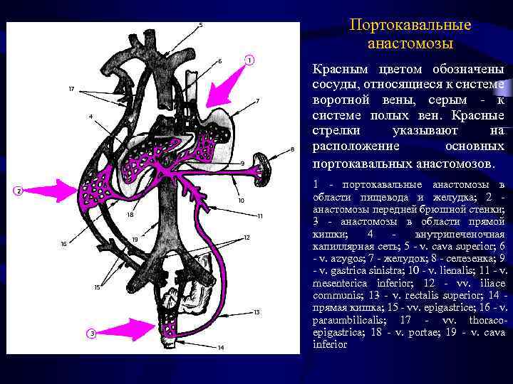 Портокавальные анастомозы Красным цветом обозначены сосуды, относящиеся к системе воротной вены, серым - к