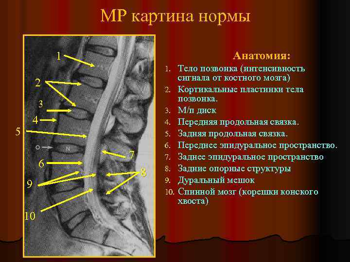 МР картина нормы Анатомия: 1 Тело позвонка (интенсивность сигнала от костного мозга) 2. Кортикальные