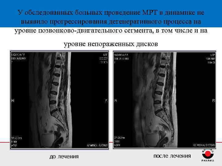 У обследованных больных проведение МРТ в динамике не выявило прогрессирования дегенеративного процесса на уровне