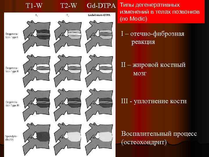 T 1 -W T 2 -W Gd-DTPA Типы дегенеративных изменений в телах позвонков (по