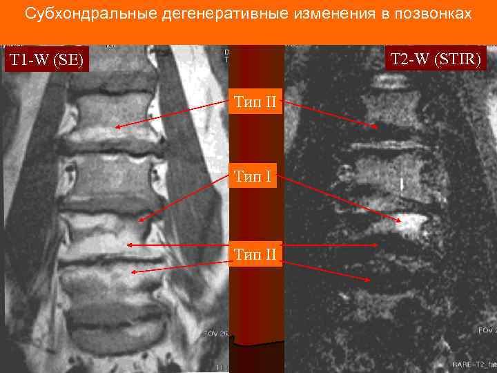 Субхондральные дегенеративные изменения в позвонках T 2 -W (STIR) T 1 -W (SE) Тип