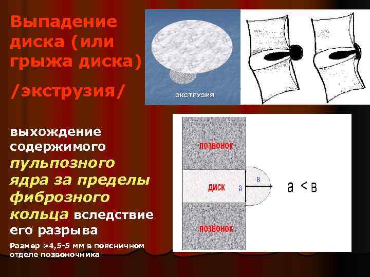 Выпадение диска (или грыжа диска) /экструзия/ выхождение содержимого пульпозного ядра за пределы фиброзного кольца