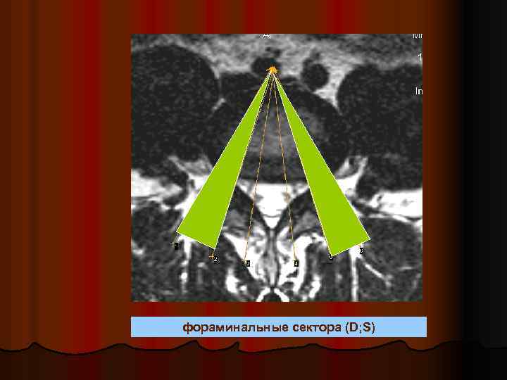 фораминальные сектора (D; S) 