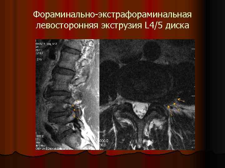 Фораминально-экстрафораминальная левосторонняя экструзия L 4/5 диска 