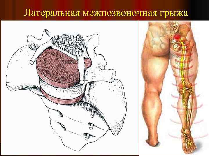 Латеральная межпозвоночная грыжа 