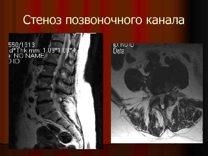 Стеноз позвоночного канала