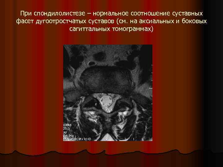 При спондилолистезе – нормальное соотношение суставных фасет дугоотростчатых суставов (см. на аксиальных и боковых