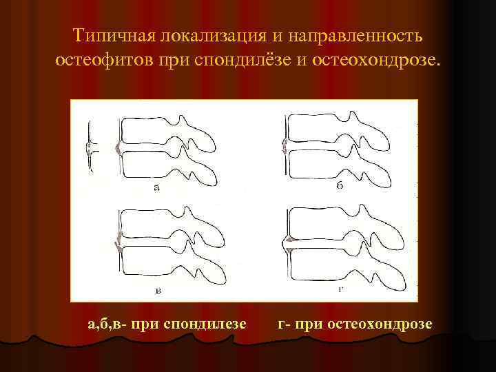 Типичная локализация и направленность остеофитов при спондилёзе и остеохондрозе. а, б, в- при спондилезе