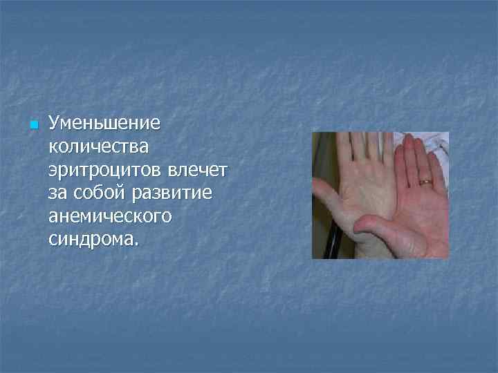 n Уменьшение количества эритроцитов влечет за собой развитие анемического синдрома. 
