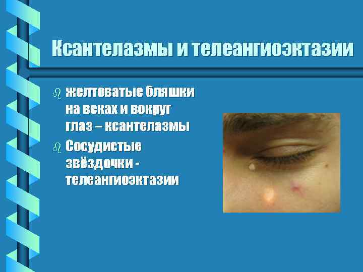 Ксантелазмы и телеангиоэктазии b желтоватые бляшки на веках и вокруг глаз – ксантелазмы b
