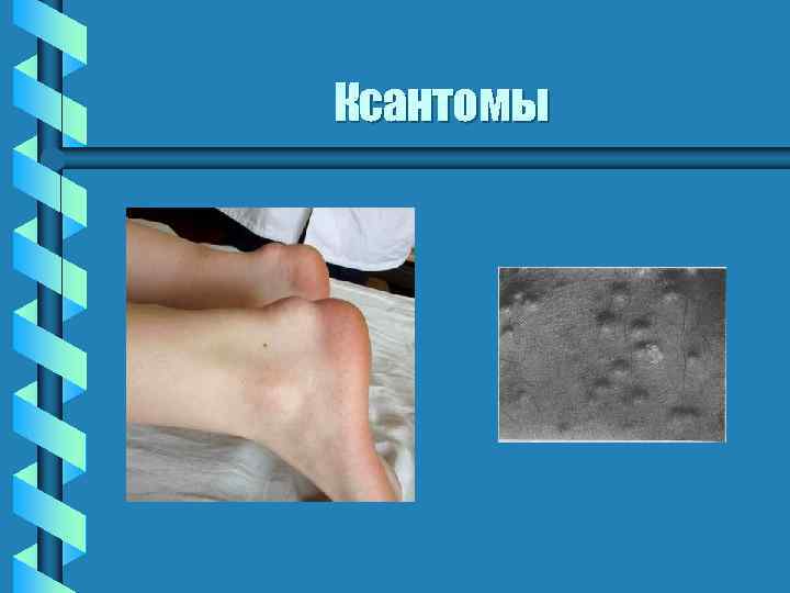 Ксантомы 