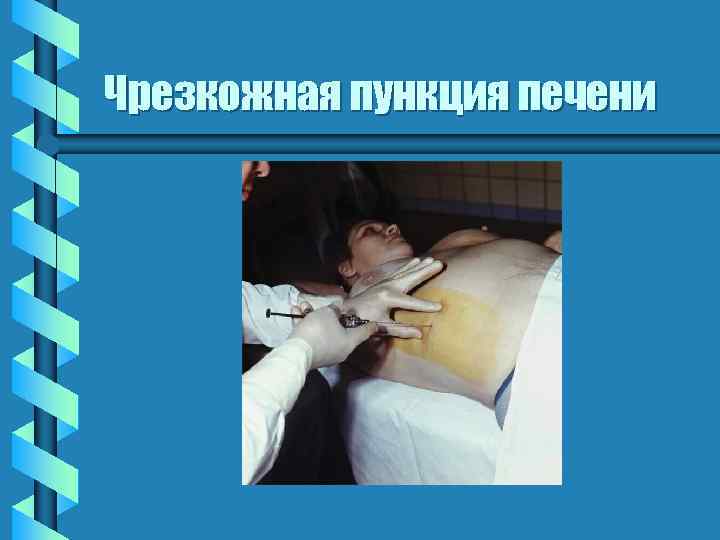 Чрезкожная пункция печени 