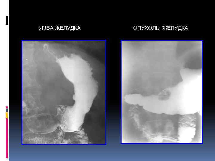 ЯЗВА ЖЕЛУДКА ОПУХОЛЬ ЖЕЛУДКА 