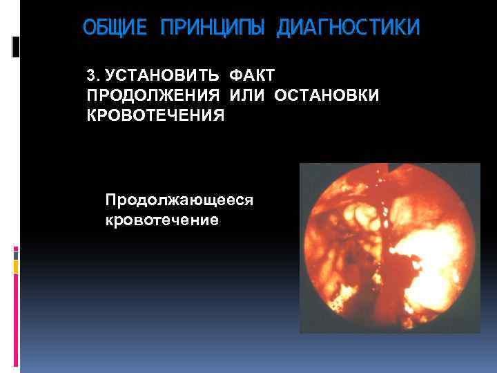 ОБЩИЕ ПРИНЦИПЫ ДИАГНОСТИКИ 3. УСТАНОВИТЬ ФАКТ ПРОДОЛЖЕНИЯ ИЛИ ОСТАНОВКИ КРОВОТЕЧЕНИЯ Продолжающееся кровотечение 