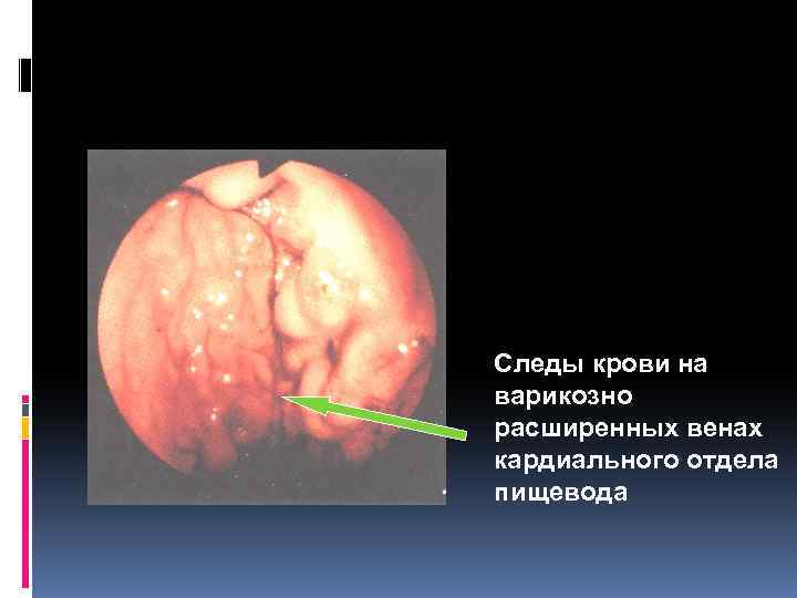 Следы крови на варикозно расширенных венах кардиального отдела пищевода 
