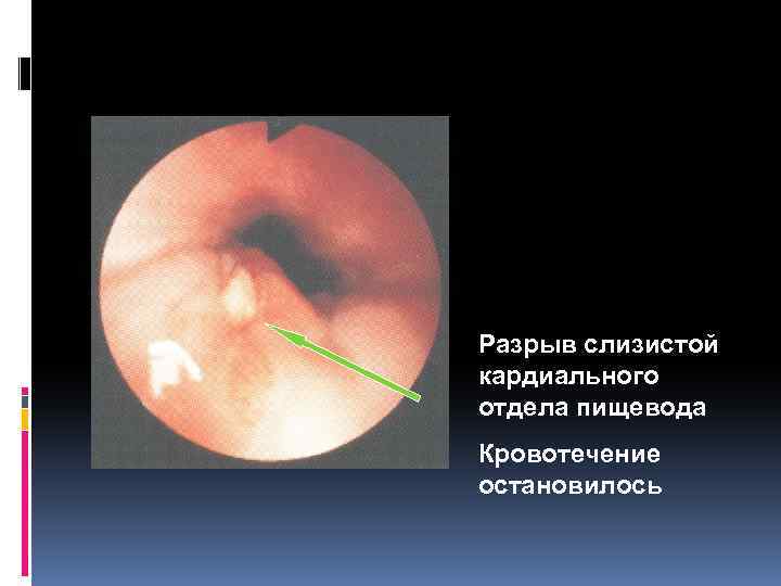 Разрыв слизистой кардиального отдела пищевода Кровотечение остановилось 