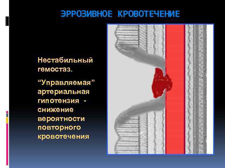 ЭРРОЗИВНОЕ КРОВОТЕЧЕНИЕ Нестабильный гемостаз. “Управляемая” артериальная гипотензия снижение вероятности повторного кровотечения 
