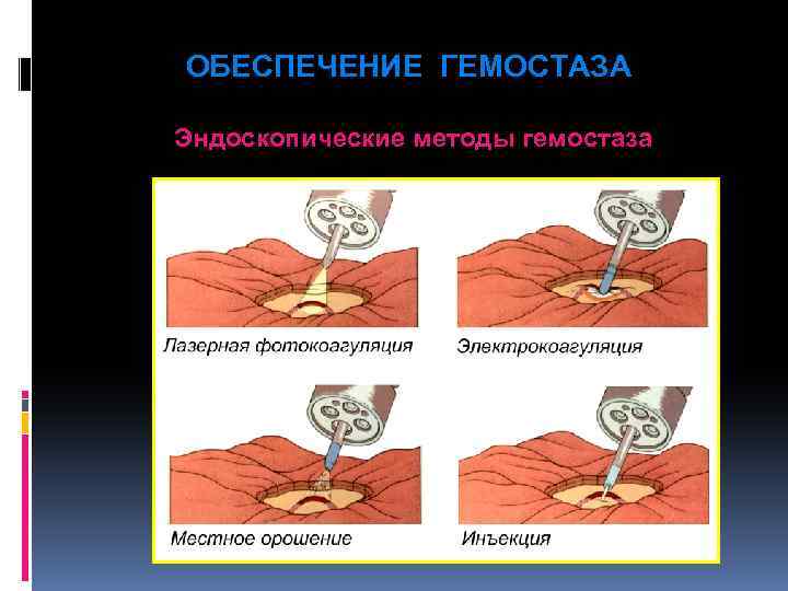 Гемостаз презентация по хирургии