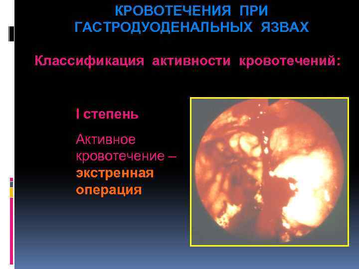 КРОВОТЕЧЕНИЯ ПРИ ГАСТРОДУОДЕНАЛЬНЫХ ЯЗВАХ Классификация активности кровотечений: I степень Активное кровотечение – экстренная операция