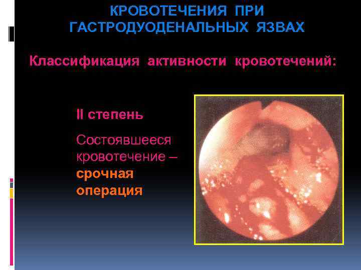 КРОВОТЕЧЕНИЯ ПРИ ГАСТРОДУОДЕНАЛЬНЫХ ЯЗВАХ Классификация активности кровотечений: II степень Состоявшееся кровотечение – срочная операция