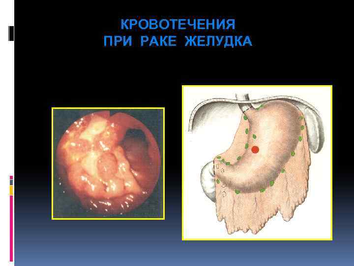 КРОВОТЕЧЕНИЯ ПРИ РАКЕ ЖЕЛУДКА 