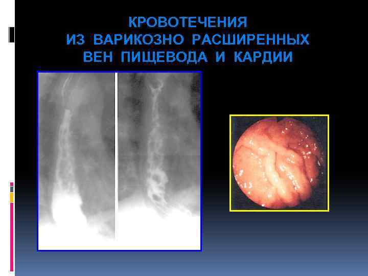 КРОВОТЕЧЕНИЯ ИЗ ВАРИКОЗНО РАСШИРЕННЫХ ВЕН ПИЩЕВОДА И КАРДИИ 