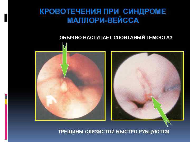 КРОВОТЕЧЕНИЯ ПРИ СИНДРОМЕ МАЛЛОРИ-ВЕЙССА ОБЫЧНО НАСТУПАЕТ СПОНТАНЫЙ ГЕМОСТАЗ ТРЕЩИНЫ СЛИЗИСТОЙ БЫСТРО РУБЦУЮТСЯ 