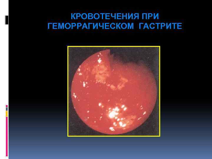 КРОВОТЕЧЕНИЯ ПРИ ГЕМОРРАГИЧЕСКОМ ГАСТРИТЕ 