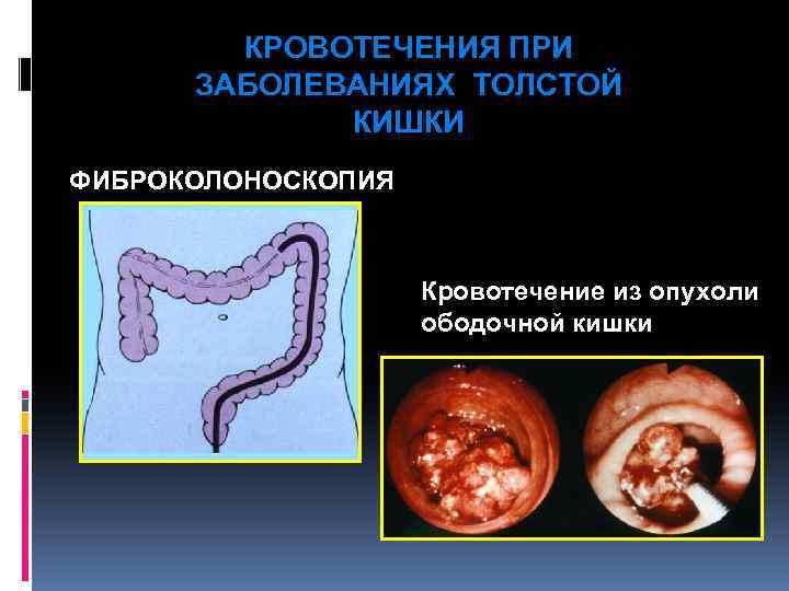 КРОВОТЕЧЕНИЯ ПРИ ЗАБОЛЕВАНИЯХ ТОЛСТОЙ КИШКИ ФИБРОКОЛОНОСКОПИЯ Кровотечение из опухоли ободочной кишки 