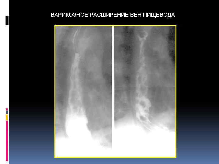 ВАРИКОЗНОЕ РАСШИРЕНИЕ ВЕН ПИЩЕВОДА 