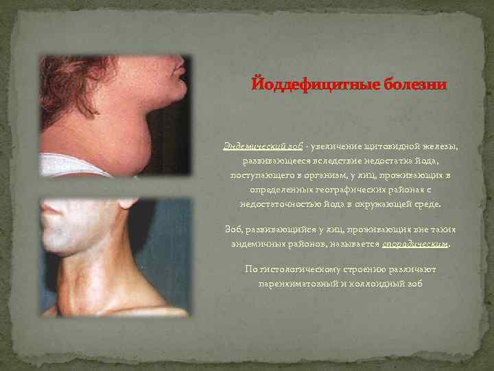 Йоддефицитные болезни Эндемический зоб - увеличение щитовидной железы, развивающееся вследствие недостатка йода, поступающего в