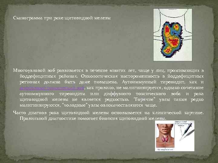 Сканограмма при раке щитовидной железы Многоузловой зоб развивается в течение многих лет, чаще у