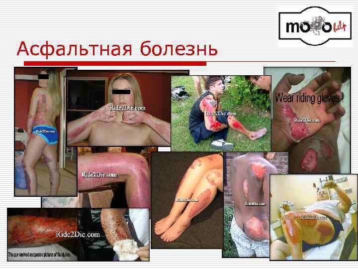 Асфальтная болезнь 