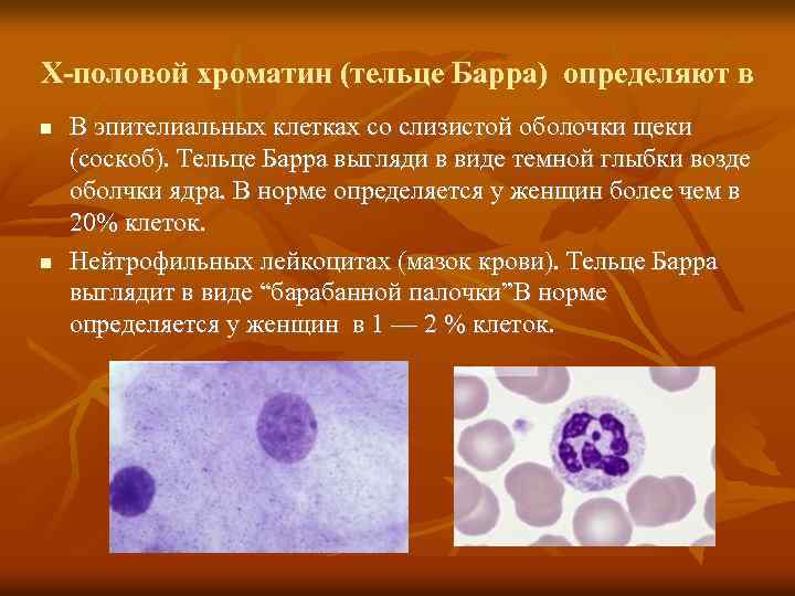 Х-половой хроматин (тельце Барра) определяют в В эпителиальных клетках со слизистой оболочки щеки (соскоб).