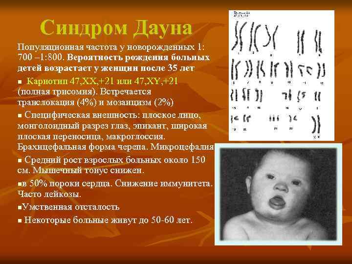 Синдром Дауна Популяционная частота у новорожденных 1: 700 – 1: 800. Вероятность рождения больных