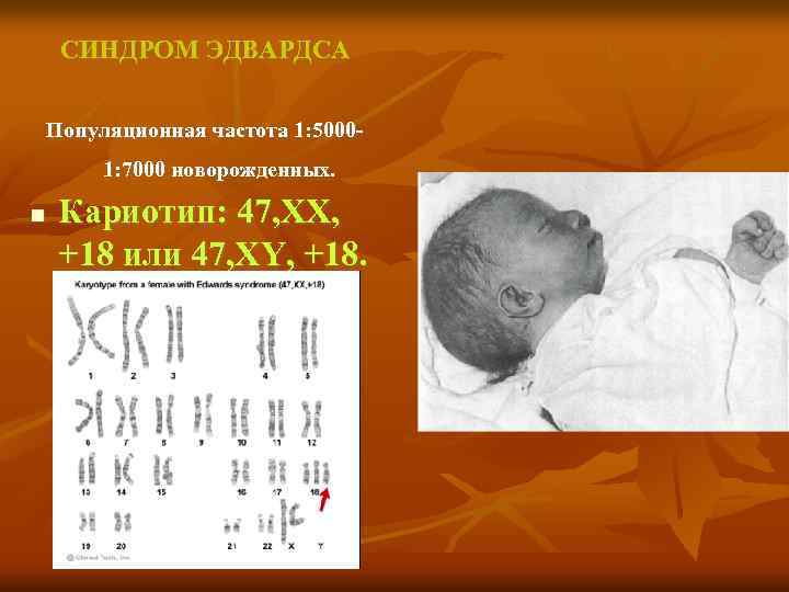 СИНДРОМ ЭДВАРДСА Популяционная частота 1: 50001: 7000 новорожденных. Кариотип: 47, ХХ, +18 или 47,