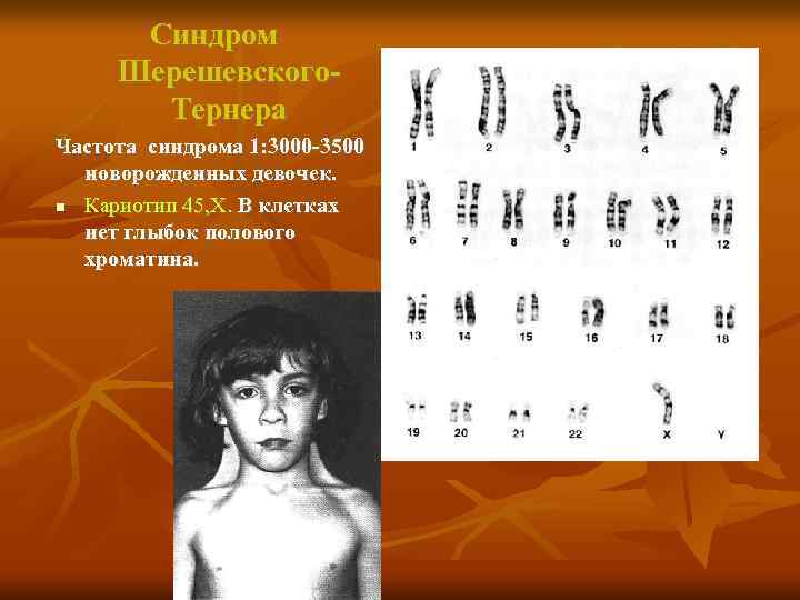 Синдром Шерешевского. Тернера Частота синдрома 1: 3000 -3500 новорожденных девочек. Кариотип 45, Х. В
