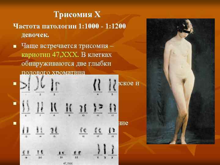 Трисомия Х Частота патологии 1: 1000 - 1: 1200 девочек. Чаще встречается трисомия –