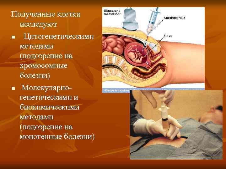 Полученные клетки исследуют Цитогенетическими методами (подозрение на хромосомные болезни) Молекулярно генетическими и биохимическими методами