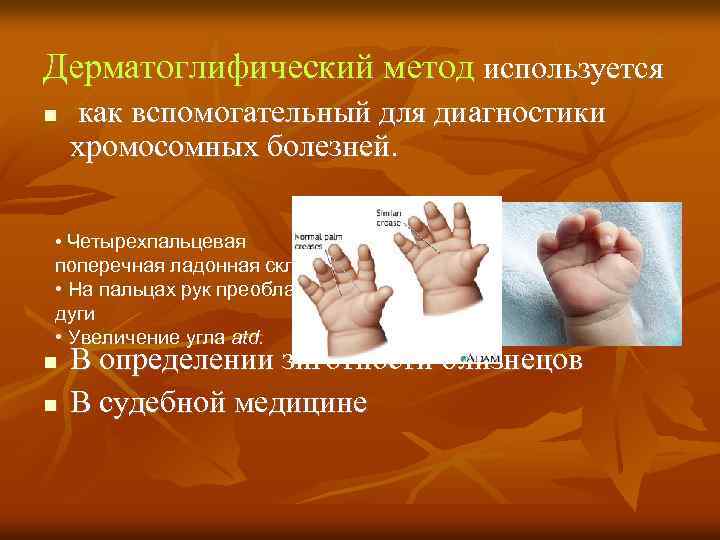 Дерматоглифический метод используется как вспомогательный для диагностики хромосомных болезней. • Четырехпальцевая поперечная ладонная складка.