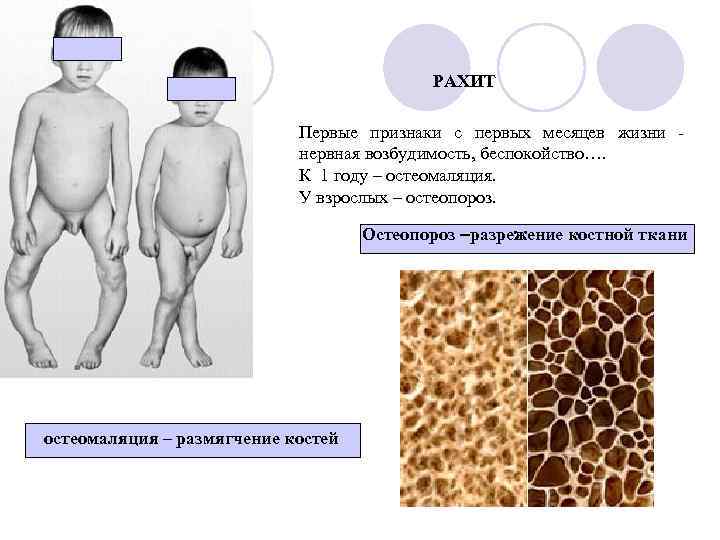 РАХИТ Первые признаки с первых месяцев жизни нервная возбудимость, беспокойство…. К 1 году –