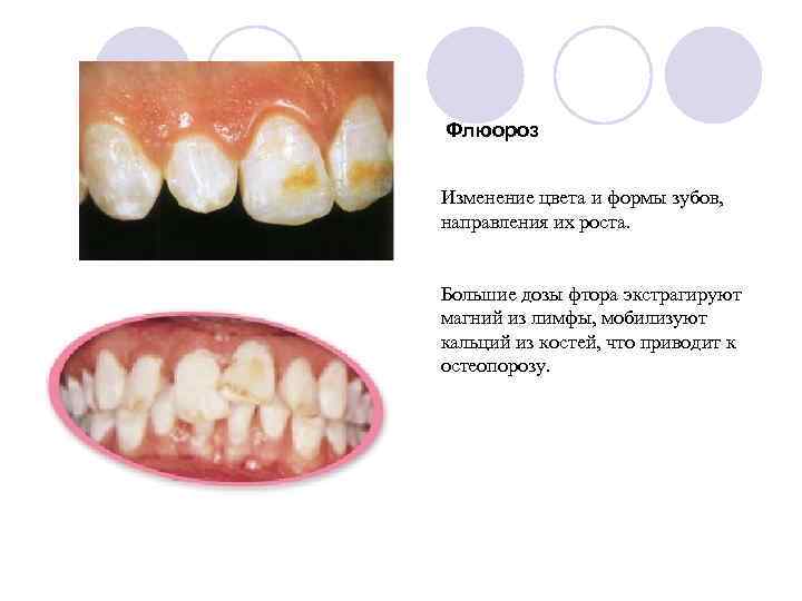 Флюороз Изменение цвета и формы зубов, направления их роста. Большие дозы фтора экстрагируют магний