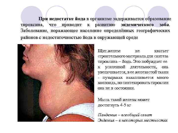 При недостатке йода в организме задерживается образование тироксина, что приводит к развитию эндемического зоба.