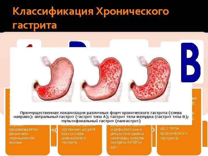 Классификация Хронического гастрита тип A (аутоиммунный) — фундальный гастрит; воспаление вызвано антителами к обкладочным