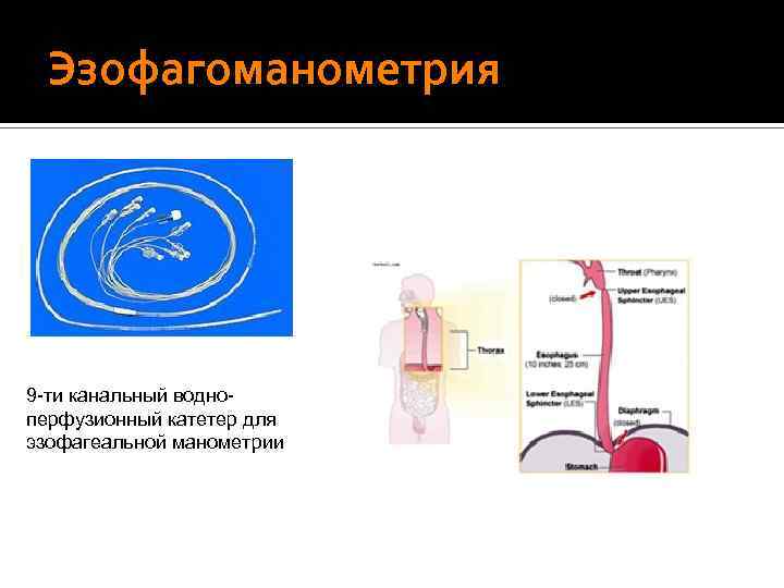 • Импедансометрический способ диагностики. Эзофагоманометрия 9 -ти канальный водноперфузионный катетер для эзофагеальной манометрии