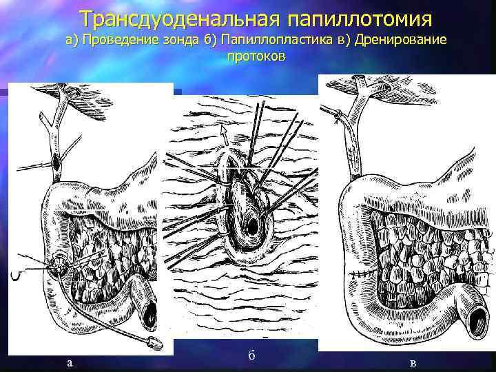 Трансдуоденальная папиллотомия а) Проведение зонда б) Папиллопластика в) Дренирование протоков а б в 