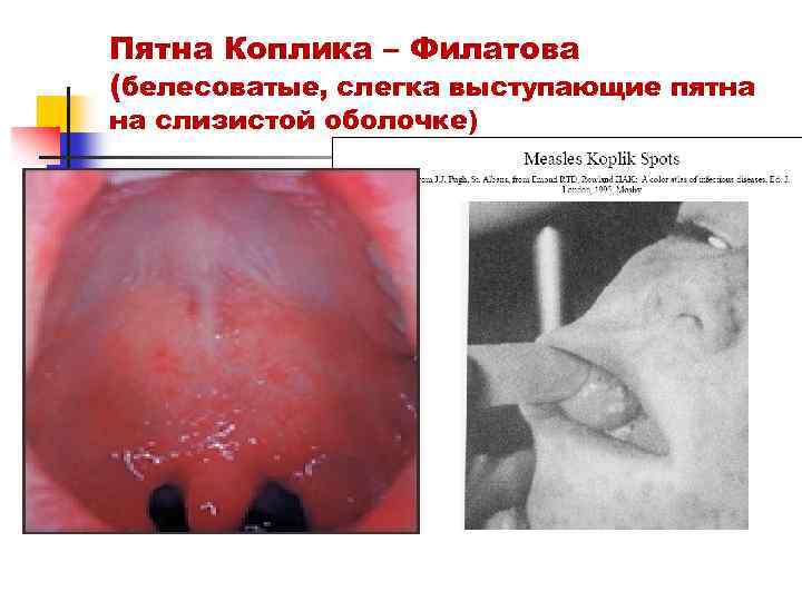 Пятна Коплика – Филатова (белесоватые, слегка выступающие пятна на слизистой оболочке) 