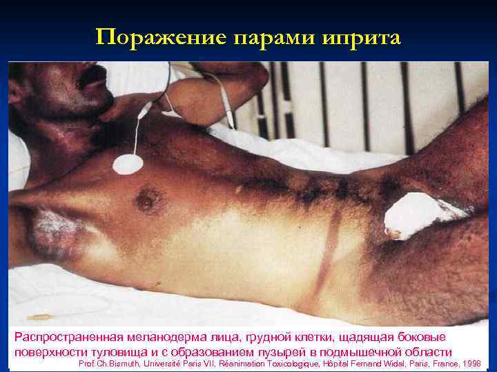 Поражение парами иприта Распространенная меланодерма лица, грудной клетки, щадящая боковые поверхности туловища и с