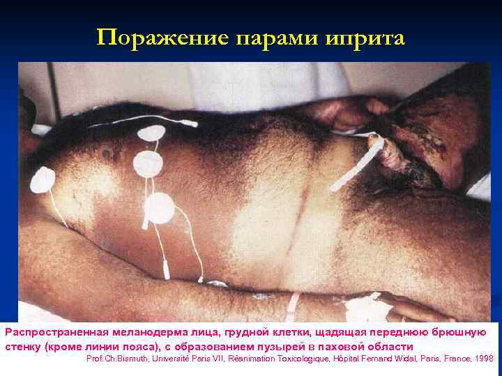 Поражение парами иприта Распространенная меланодерма лица, грудной клетки, щадящая переднюю брюшную стенку (кроме линии